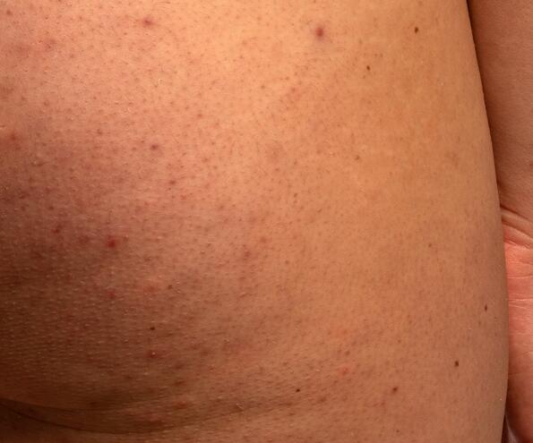 Spots on the buttocks